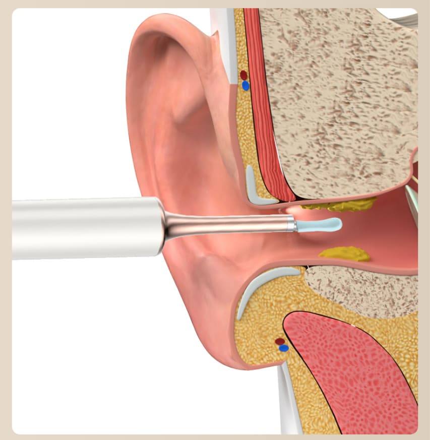 засіб для видалення вушної сірки очищення вуха